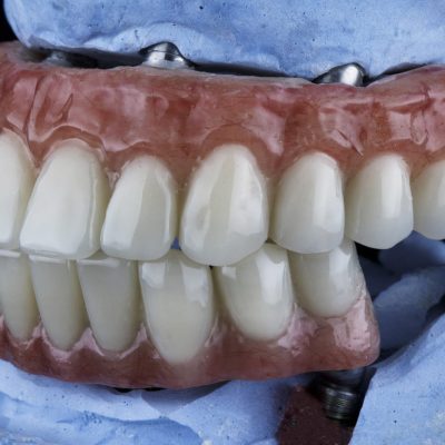 dentures-upper-lower-jaw-blue-plaster-model dentures-upper-lower-jaw-blue-plaster-model